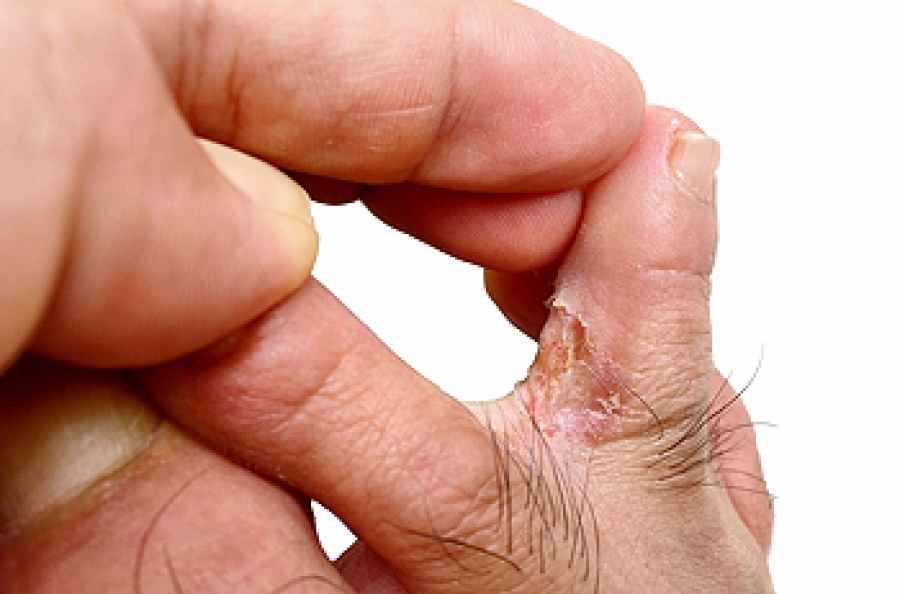 Preventing Athlete’s Foot and Eczema Flare-Ups
